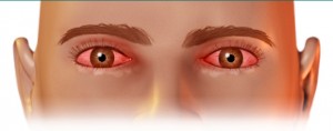 Informe SP reporta cuatro casos de conjuntivitis; clínica advierte de incremento de casos