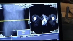 RD registra 400 casos de cáncer de próstata cada año