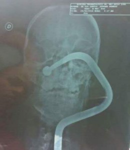 Se recupera joven cuyo ojo fue atravesado por metal