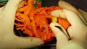 Corazón 3D le salva la vida a un niño en Argentina
