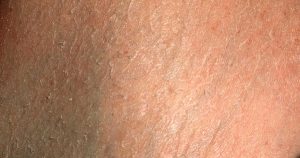 Conozca cuáles son los aspectos dermatológicos de la diábetes