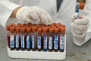 Científicos españoles descubren un marcador de tumor cerebral en sangre