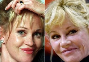 Melanie Griffith, considerada uno de los rostros más bellos del cine en los años ochenta, ha admitido que las cirugías y procedimientos estéticos a los que se sometió a lo largo de los años acabaron desfavoreciendo su aspecto.
