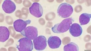 Especialistas estudian terapia genética contra leucemia 