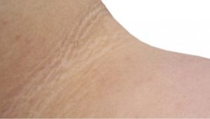 ¿Qué es la Acantosis Nigricans?