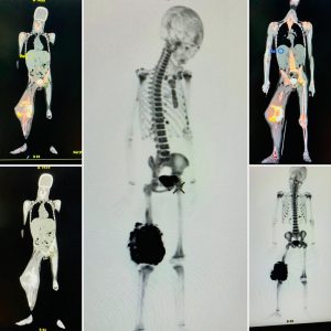 Estudio PETCT Óseo ya es posible realizarlo en República Dominicana