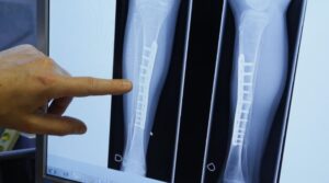 Los veganos son un 43% más vulnerable a las fracturas de huesos que los consumidores de carne