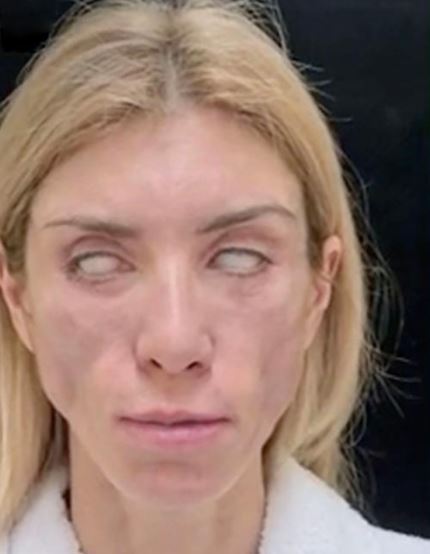 Así quedó Yulia Tarasevich luego de la cirugía. 