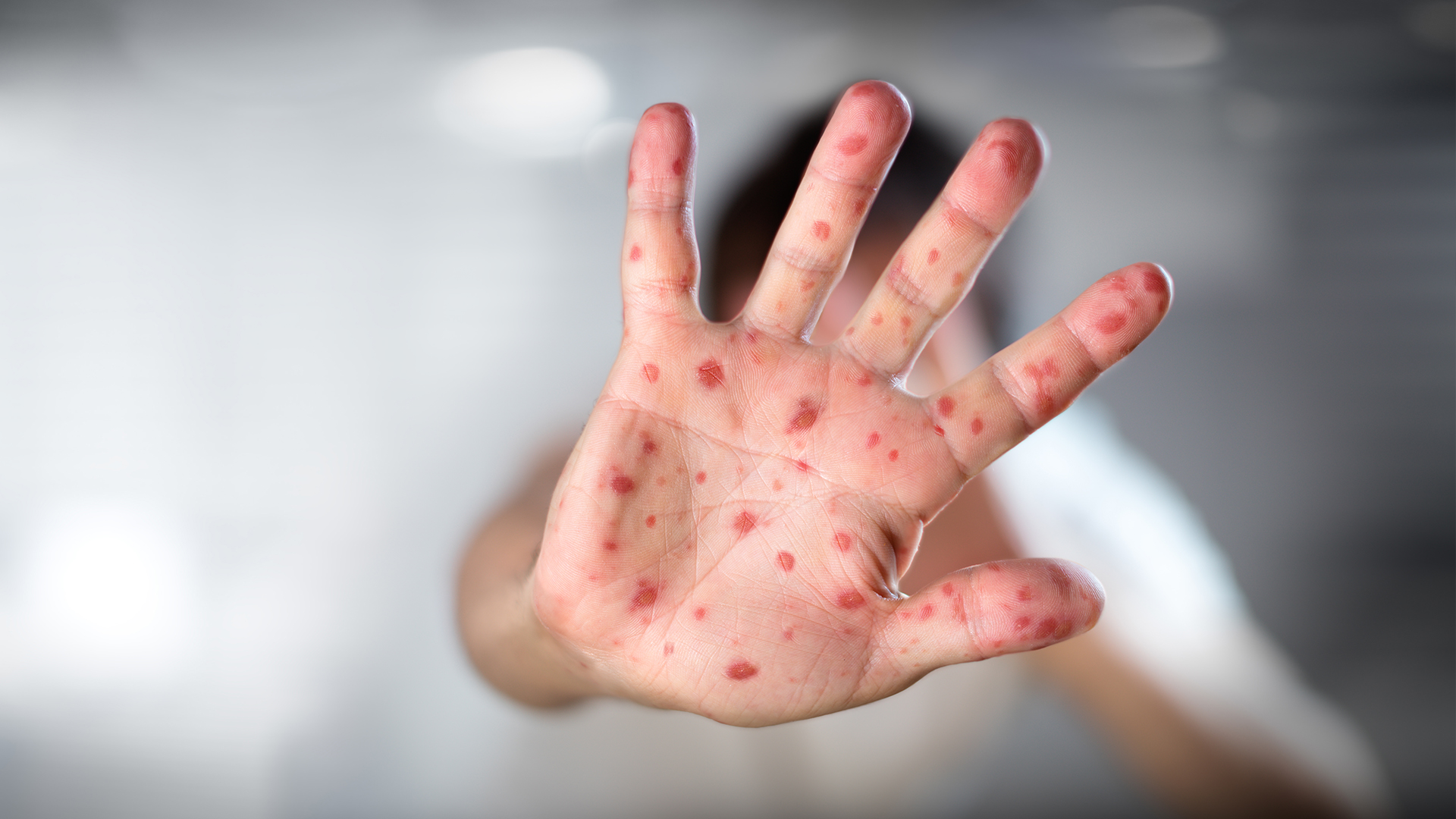 Contagios de viruela del mono: ¿Cómo se producen?