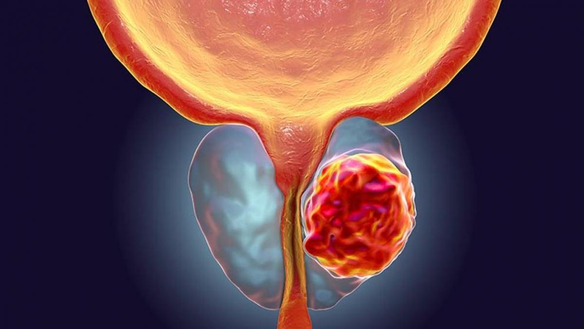Día Mundial del Cáncer de Próstata; segundo que más afecta a hombres