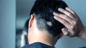 En EE.UU. se aprueba el primer tratamiento de la alopecia
