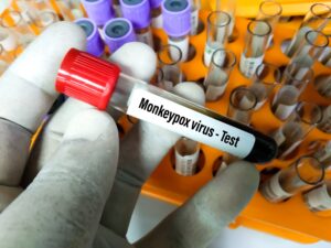 Tras 15 días de ingreso continúa presentando mejoría paciente con Viruela Símica en RD